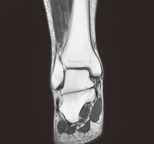 足関節MRI画像正常解剖ツール！３方向！苦手な人もこれで大丈夫！